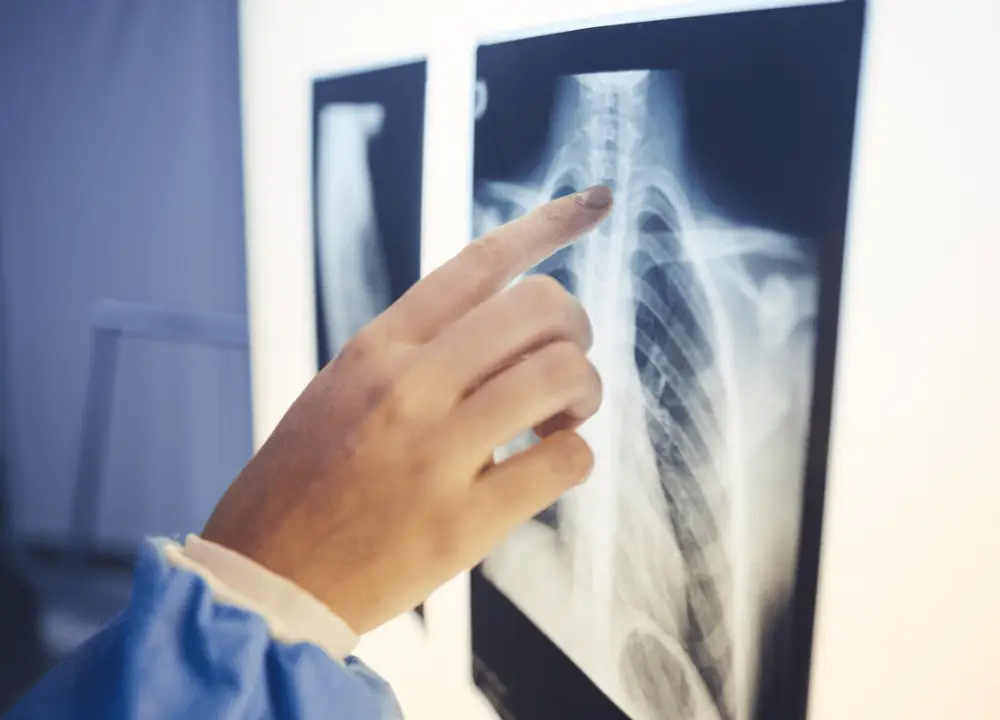 X-ray showing broken ribs after a car accident.